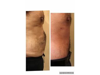 Abdominoplastia