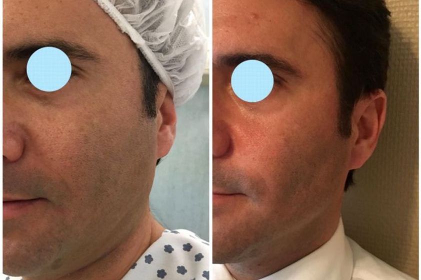 Bichectomia antes y después - 638457