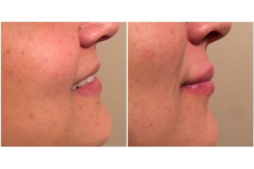 Rellenos faciales antes y después - 638462