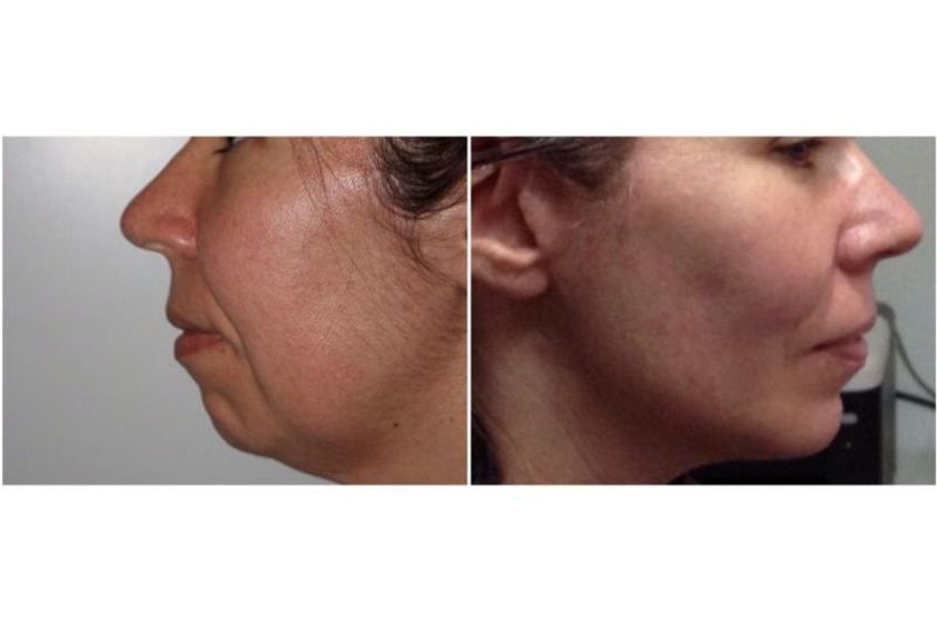 Mentoplastia antes y después - 638478