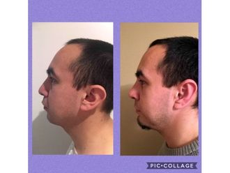 Mentoplastia - 638479