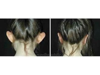 Otoplastia - 638481