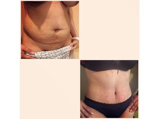 Abdominoplastia