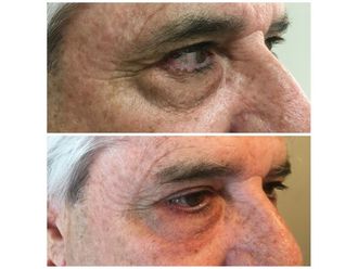 Blefaroplastia - 648333