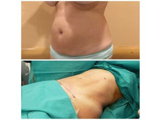 Abdominoplastia