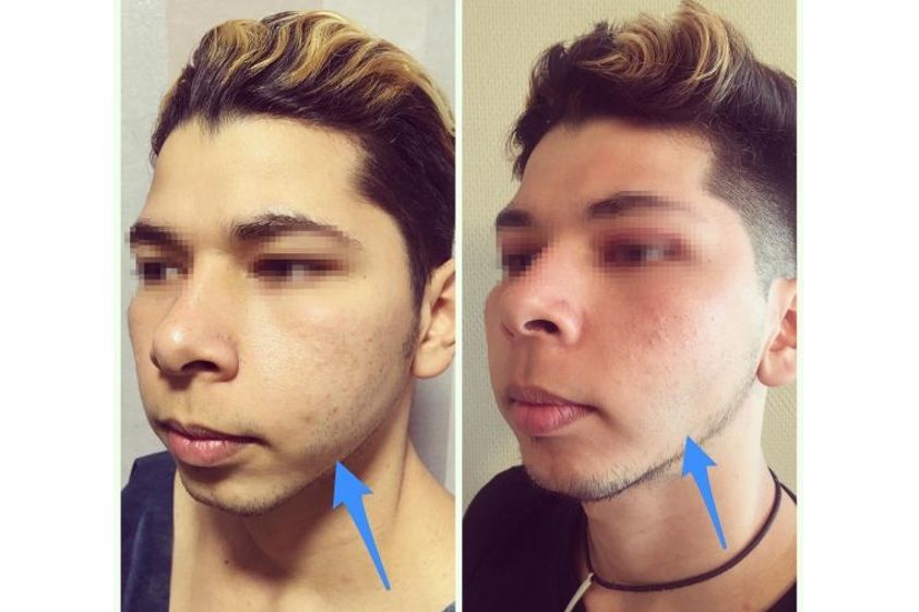 Bichectomia antes y después - 648342