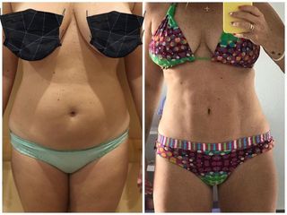 Abdominoplastia
