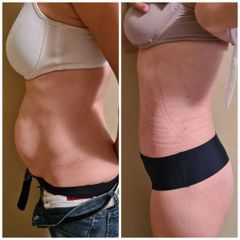 Abdominoplastia - Dr. Zuccardi Santiago