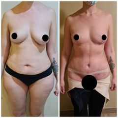 Lipoescultura - Dr. Zuccardi Santiago