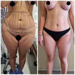 Lipoescultura - Dr. Zuccardi Santiago