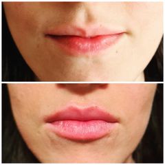 Relleno de labios - Dr. Zuccardi Santiago
