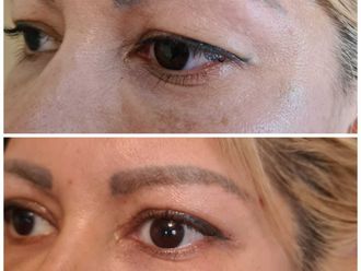 Blefaroplastia - 788162