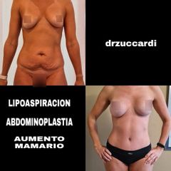 Lipoescultura - Dr. Zuccardi Santiago