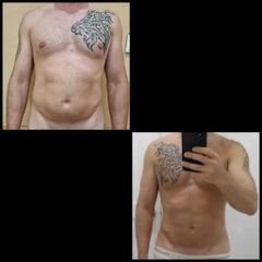 Abdominoplastia - Dr. Zuccardi Santiago