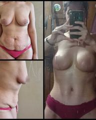 Abdominoplastia - Dr. Zuccardi Santiago