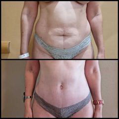 Abdominoplastia - Dr. Zuccardi Santiago