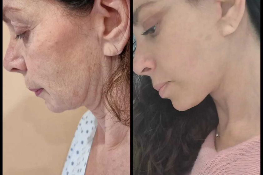 Lifting antes y después - 850287