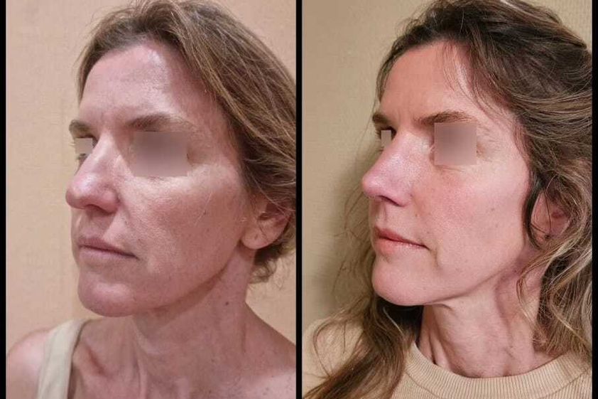Lifting antes y después - 863625