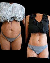 Abdominoplastia - Dr. Zuccardi Santiago