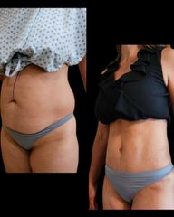 Abdominoplastia - Dr. Zuccardi Santiago