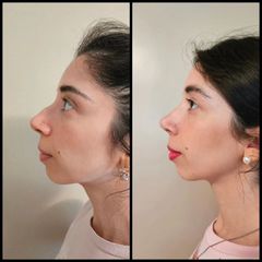 Rinoplastia - Dr. Zuccardi Santiago