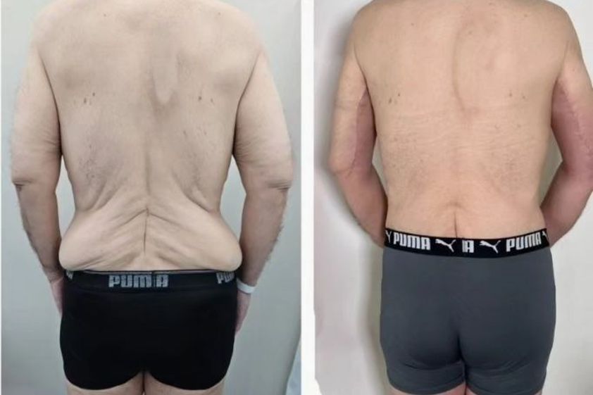 Liposucción antes y después - 866152
