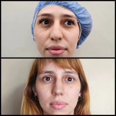 Rinoplastia - Dr. Zuccardi Santiago