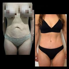 Abdominoplastia - Dr. Zuccardi Santiago