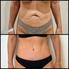 Abdominoplastia - Dr. Zuccardi Santiago