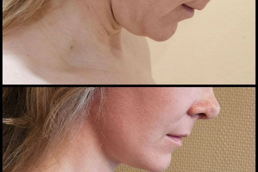 Lifting antes y después - 866167