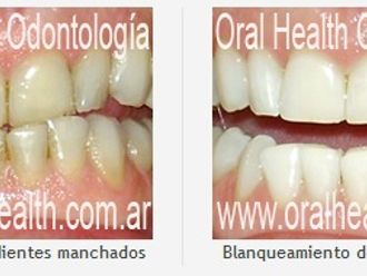 Blanqueamiento dental-280053