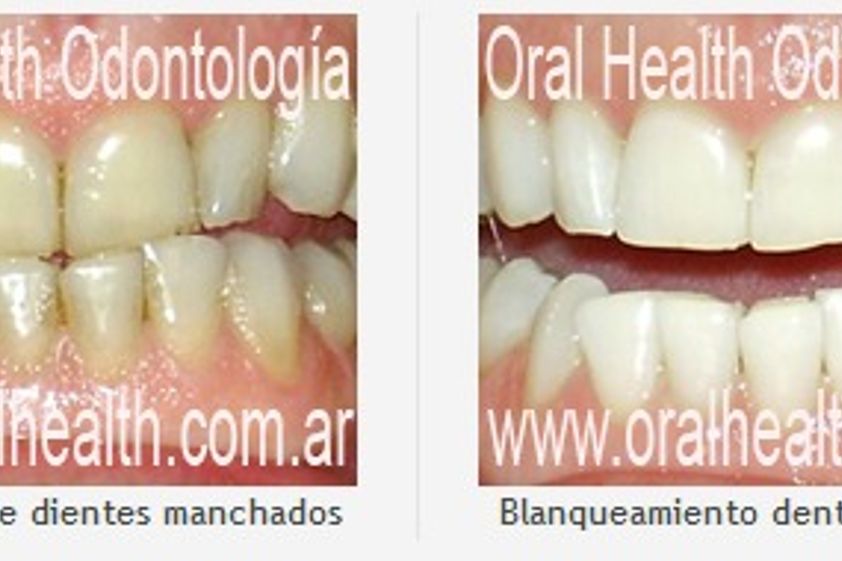 Blanqueamiento dental antes y después - 280053