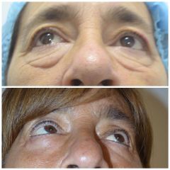 Blefaroplastia - Dr. Javier Recchiuto