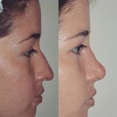 Rinoplastia - Dr. Javier Recchiuto