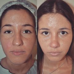 Rinoplastia - Dr. Javier Recchiuto