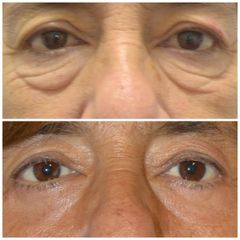 Blefaroplastia - Dr. Javier Recchiuto