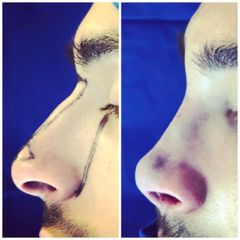 Rinoplastia - Dr. Javier Recchiuto