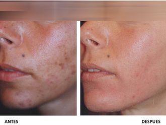 Peeling antes y después - 265286