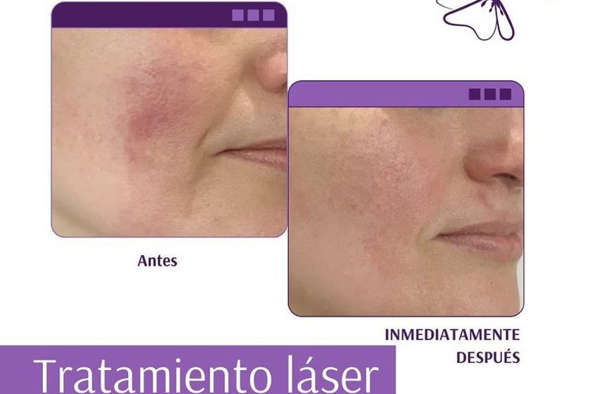 Rosácea antes y después - 822486