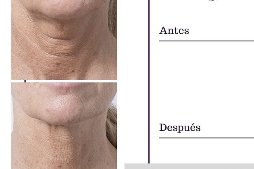Mesoterapia antes y después - 822489