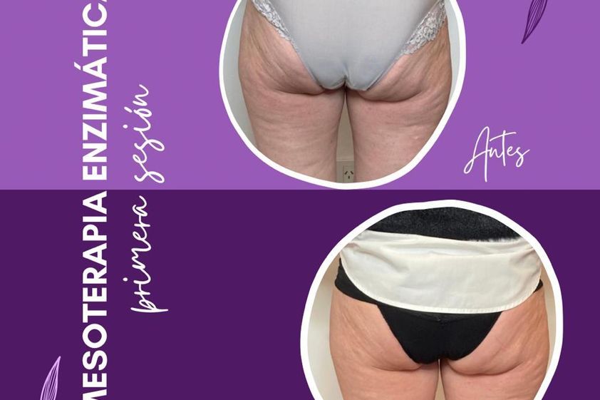 Mesoterapia antes y después - 832003