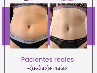 Radiofrecuencia antes y después - 832005