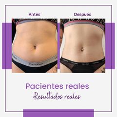 Radiofrecuencia con Mesoterapia - Centro IMEL