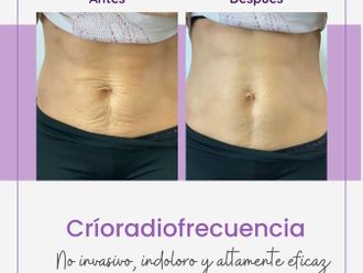 Radiofrecuencia antes y después - 848676