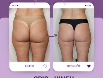 Criolipólisis antes y después - 848679