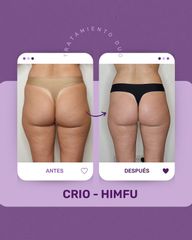 Criolipólisis - Centro IMEL