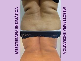Mesoterapia antes y después - 848680