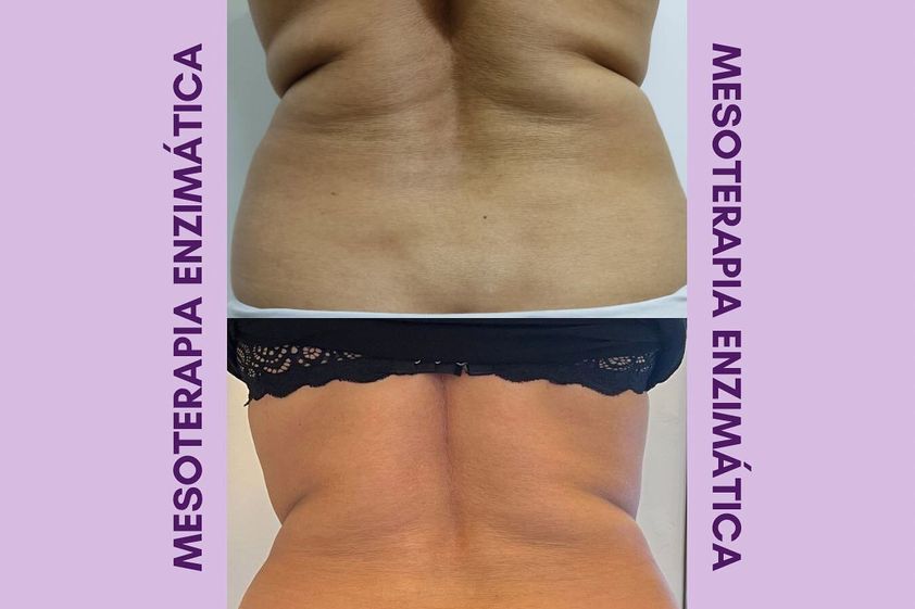 Mesoterapia antes y después - 848680