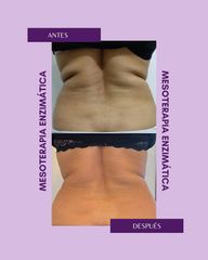 Mesoterapia - Centro IMEL
