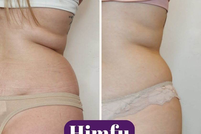 HIFU antes y después - 848683
